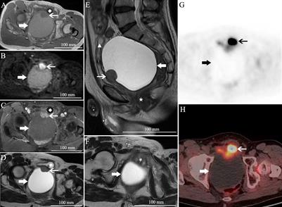 Case report: Giant unilocular prostate cystadenoma: A rarer condition with a single cystic mass